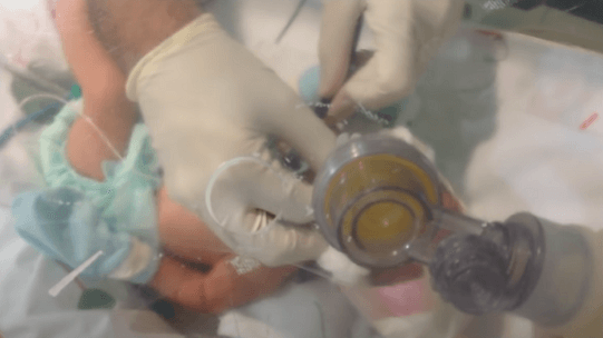 Neonatal Digital Intubation Part 2